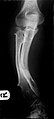 Multiple osteochondromas causing deformity of the forearm (shortening of the Radius with secondary bowing of the Ulna).