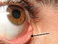 A close up of a lacrimal punctum.