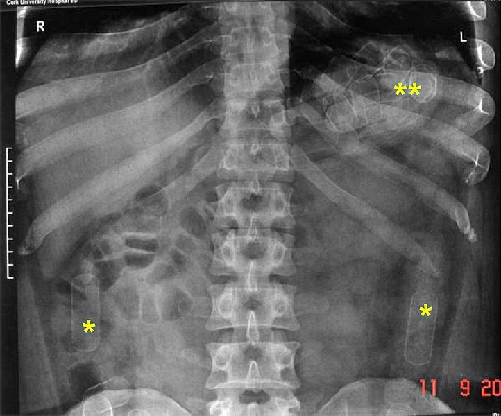 File:Drug-Packer X-Ray.jpg