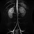 Contrast enhanced MRA of the abdominal aorta demonstrating normal paired arteries.